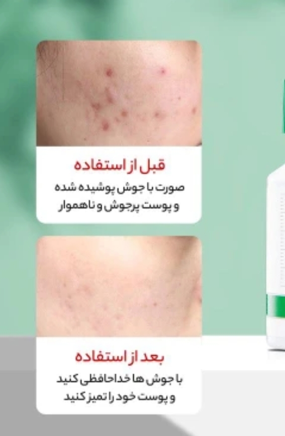 قطره مدل ضد جوش نواحی حساس وصورت از برند سالیسلیک
